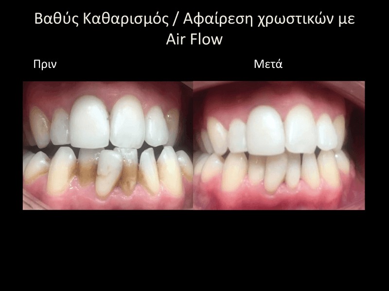 Καθαρισμός δοντιών με air flow πριν και μετά γλυφάδα