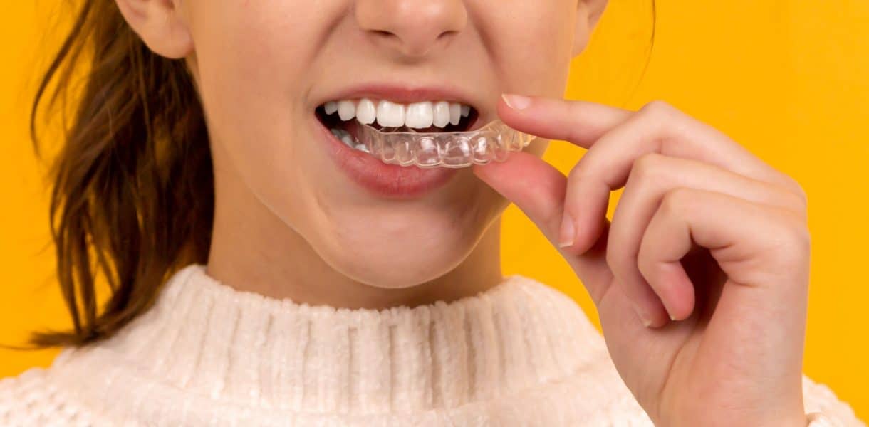 Invisalign – Οι διαφανείς νάρθηκες για ίσια δόντια