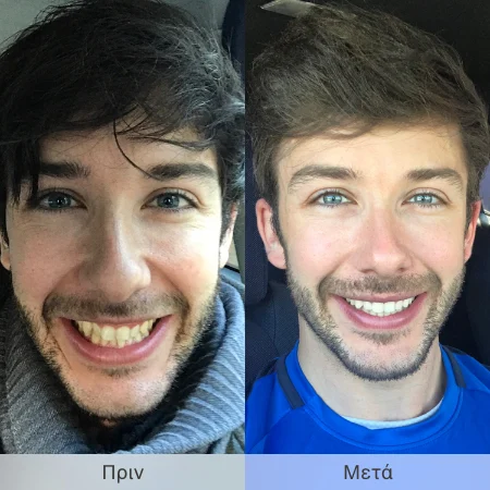 Invisalign® Πριν & Μετά