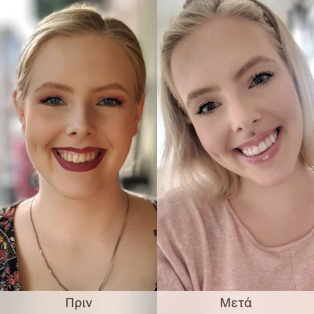 Invisalign® Πριν & Μετά