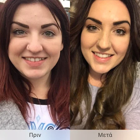 Invisalign® Πριν & Μετά