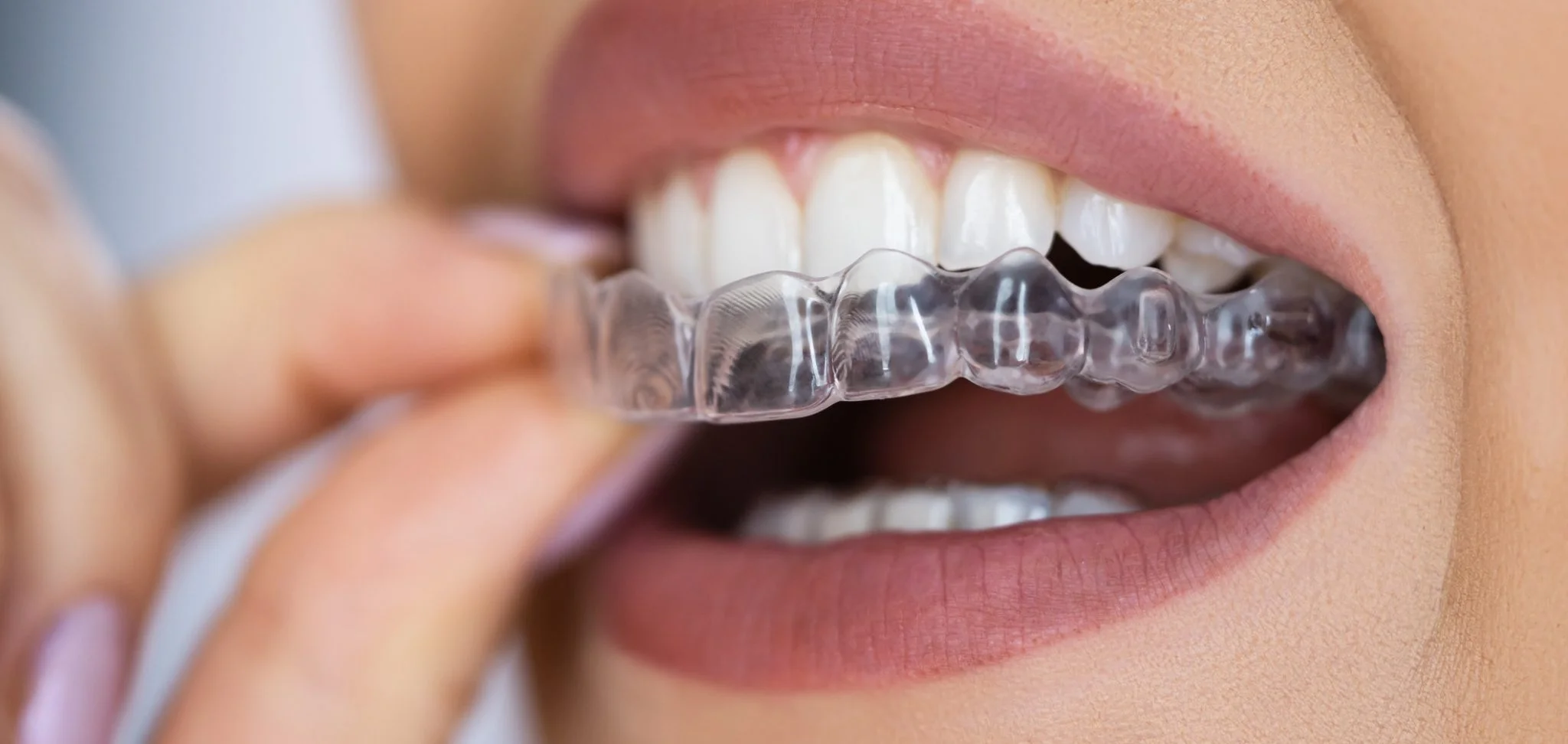 Invisalign Γλυφάδα Οδοντίατρος Μαρία Λαλούση Γλυφάδα